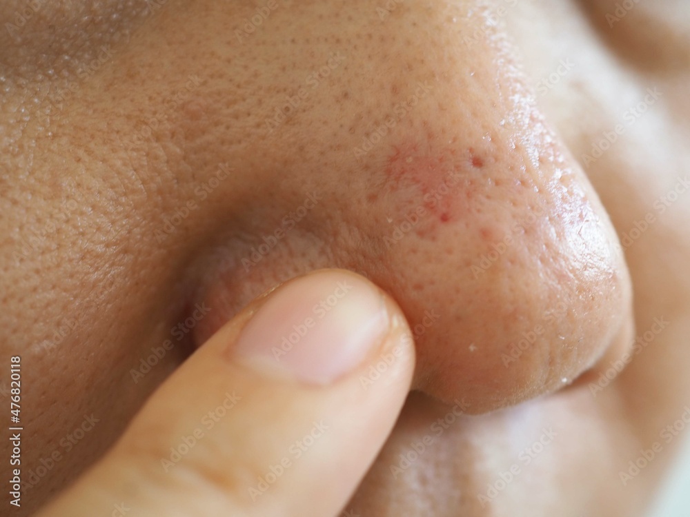 Woman pointing to red acne marks on nose. closeup photo, blurred. Woman pointing to red acne marks on nose. closeup photo, blurred.