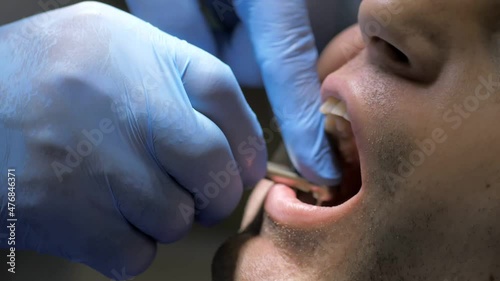 Installation of a dental implant. Restoration of missing teeth with an implant. Installation of veneers in modern dentistry for a young man. The concept of dentistry and dental care. Close-up