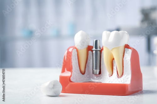 Educational model with post and abutment of dental implant between teeth on white table indoors. Space for text photo