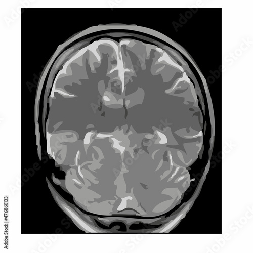 mri of the brain of an adult male on a black background.