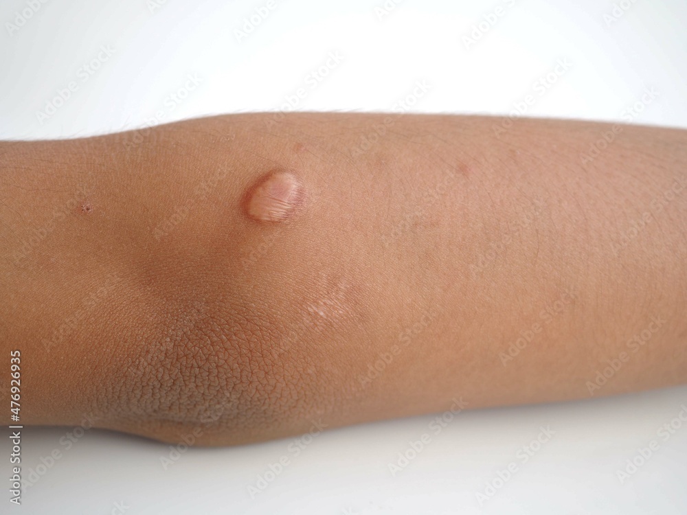 Naklejka premium A scar on a kid boy arm. closeup photo, blurred.