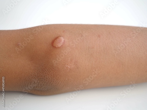 A scar on a  kid boy arm. closeup photo  blurred.