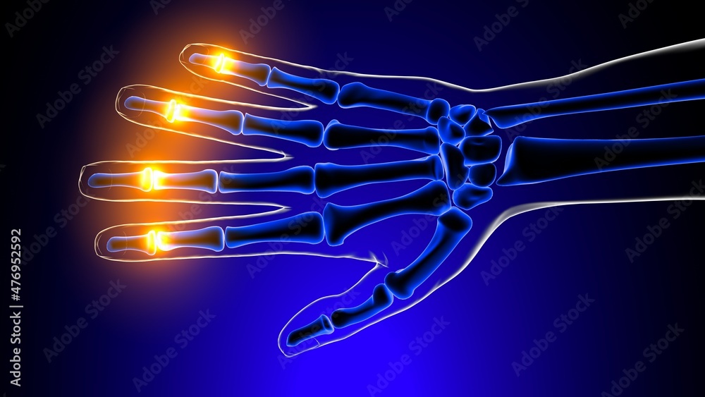 Distal interphalangeal joints pain Anatomy For Medical Concept 3D Stock Illustration Adobe Stock