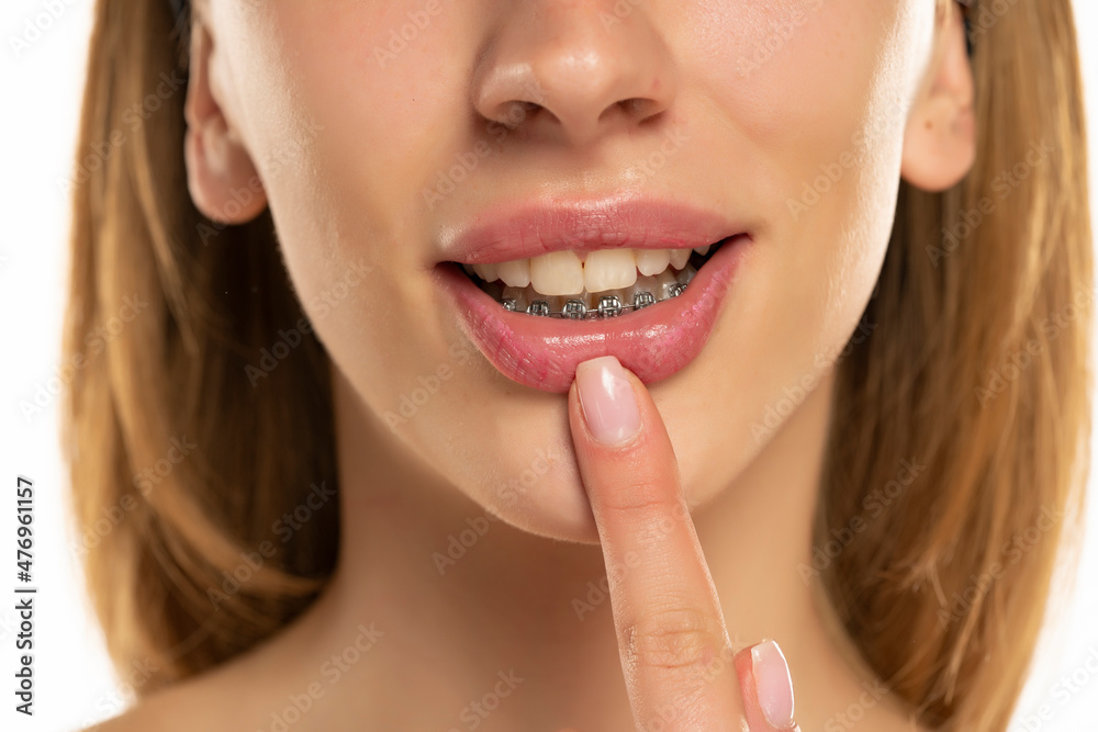Woman showing her dentures on lower teeth. Woman showing her dentures on lower teeth.