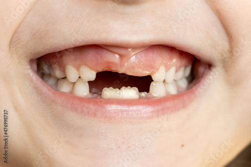 Wall Mural Close-up of a 6-7 year old girl with newly erupting teeth