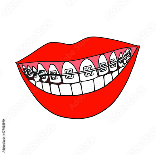 Smile with braces. Invisible braces and brackets on tooth set. Dental invisalign braces vs metal white tooth orthodontic correction treatment concept. Vector