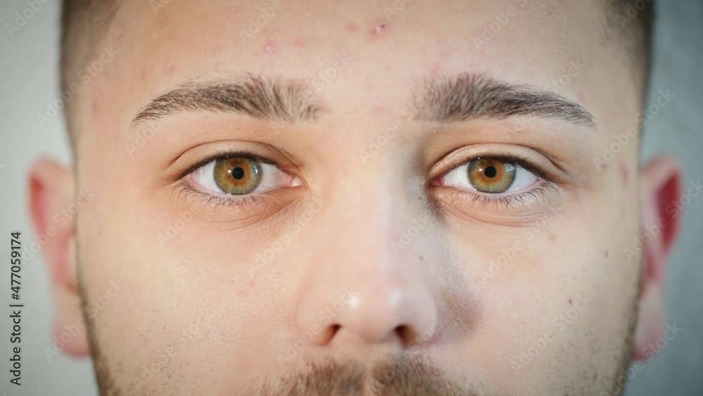 Portrait close up of man's face with acne skin condition opening hazel eyes. Young Arab male model with natural central heterochromia and pimples on skin looking at camera. Slow-motion, 4K. Portrait close up of man's face with acne skin condition opening hazel eyes. Young Arab male model with natural central heterochromia and pimples on skin looking at camera. Slow-motion, 4K.