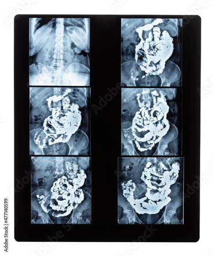 film with set of X-ray radiogram with Barium studies of small bowel isolated on white background