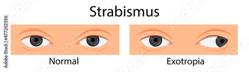Types of strabismus. Hypotropia, hypertropia, exotropia, esotropia. cartoon style photo