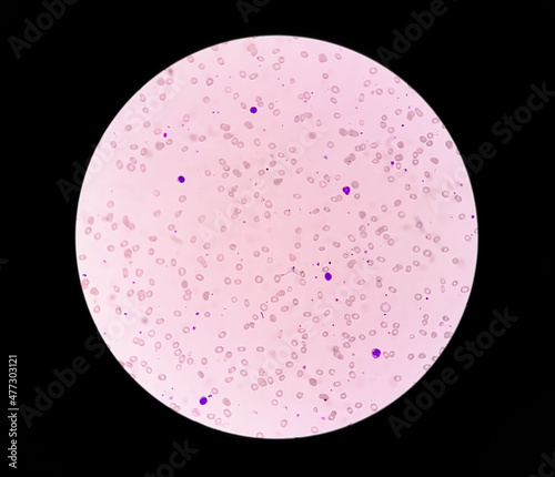 Photomicrograph of Leuco-erythroblastic anemia. 40X photo