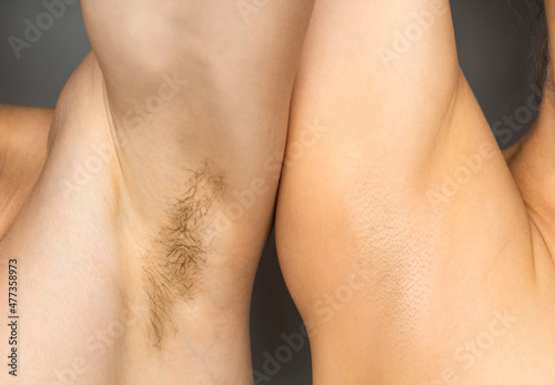 Two armpits with and without hair. Laser hair removal concept. photo