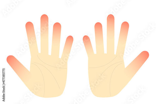 手荒れのイラスト。あかぎれ、しもやけ、手湿疹。