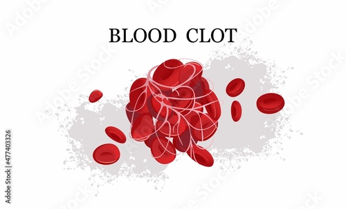 Blood clot thrombus medical poster