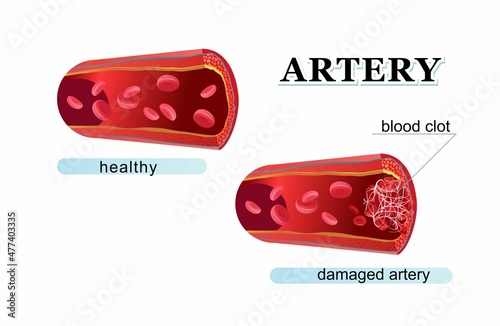 Blood clot thrombus medical poster