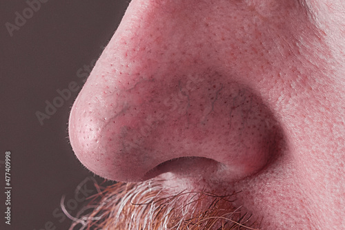 the surface of the skin on the nose in rosacea and eczema photo
