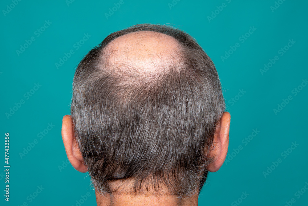 Obraz premium A closeup of a half-bald male head, hair transplant concept for hair loss