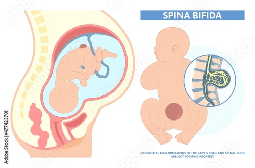 Spina bifida Pregnancy non invasive neural tube gene AFP NTD infant cord folate folic acid serum level sacral dimple child Lumbar birth NIPT test fetus born baby spine blood fluid villus alpha photo