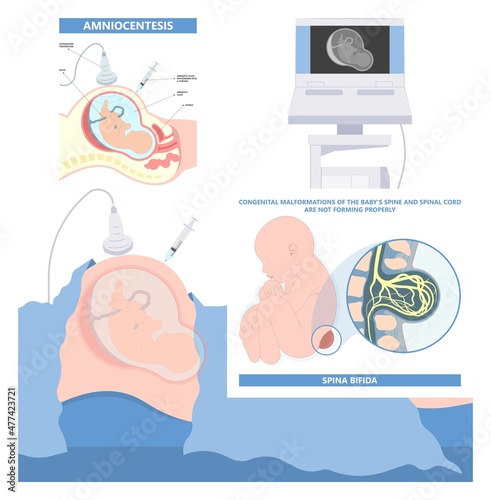 Spina bifida Pregnancy non invasive neural tube gene AFP NTD infant cord folate folic acid serum level sacral dimple child Lumbar birth NIPT test fetus born baby spine blood fluid villus alpha