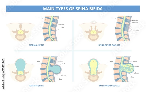 Spina bifida Pregnancy non invasive neural tube gene AFP NTD infant cord folate folic acid serum level sacral dimple child Lumbar birth NIPT test fetus born baby spine blood fluid villus alpha
