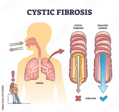 Cystic fibrosis disorder or healthy airflow airway comparison outline diagram. Labeled educational medical disease explanation with anatomical human pulmonary organ differences vector illustration.