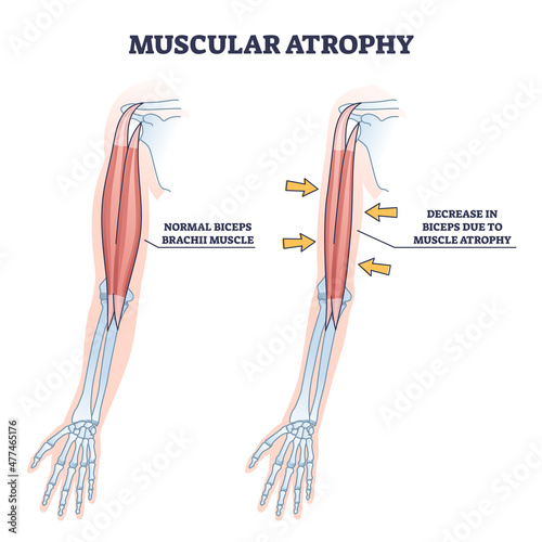 Muscular atrophy or SMA disorder example compared to healthy outline diagram. Labeled educational medical illness with abnormal muscle weakness and normal movement disability vector illustration.