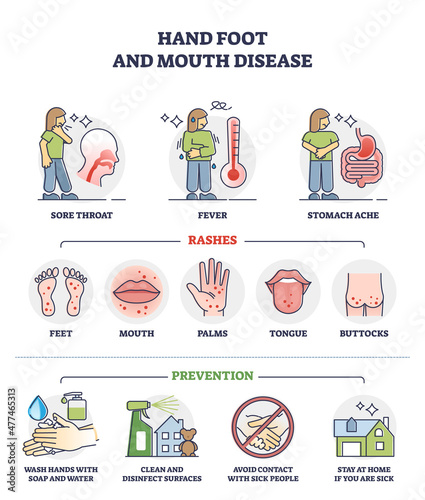 Hand, foot and mouth disease with rashes and how to avoid outline diagram. Labeled educational illness prevention tips to stay healthy without sore throat, fever and stomach ache vector illustration.