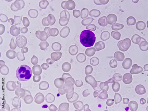 Blood smear leishman stained Microscopic show zooming image of hereditary haemolytic anemia also called Thalassemia and thrombocytopenia.