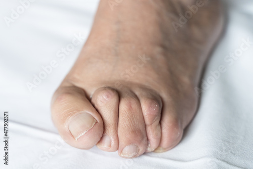 Bunion on foot of senior man with hammer toes and dry skin over white background. Hygiene, surgery, health care, podiatrist, dermatology concepts