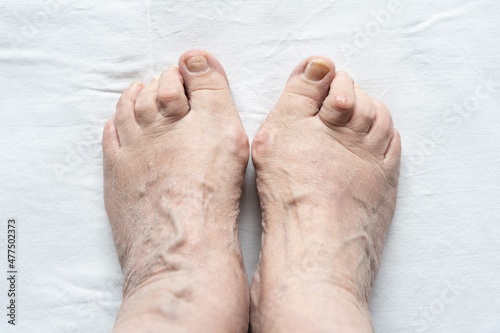 Top view of female feet together with hammer toes, broken nails and dry skin over white background. Hygiene, medical, health care, podiatrist, dermatology concepts