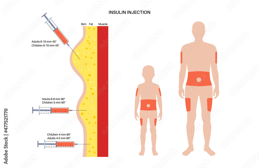 Insulin Injection Sites Stock Vector Adobe Stock Insulin Injection Sites Stock Vector Adobe Stock