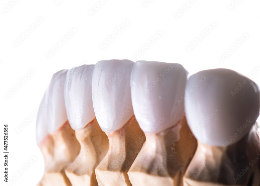 Naklejka premium press ceramic crowns and veneers natural color
