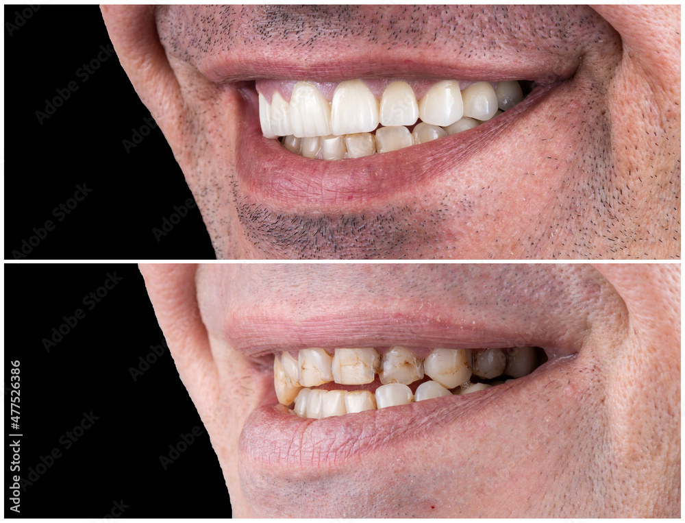 Obraz premium press ceramic crowns and veneers natural color