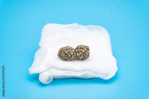large gallstones close up on a sterile napkin photo