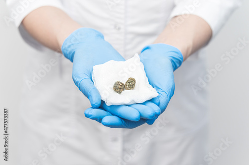 gallbladder stones after surgery in the hands of a doctor