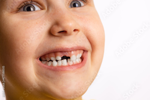 Close-up of cute young girl face smiling showing missing front milk tooth looking up on white background. First teeth changing going to dentist to do tooth treatment. 