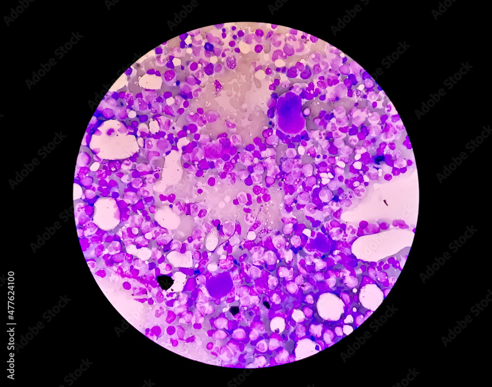 Bone marrow from posteriosuperior iliac spine Leishman's stained microscopic 100x zooming show Mylodysplastic anaemia Bone marrow from posteriosuperior iliac spine Leishman's stained microscopic 100x zooming show Mylodysplastic anaemia