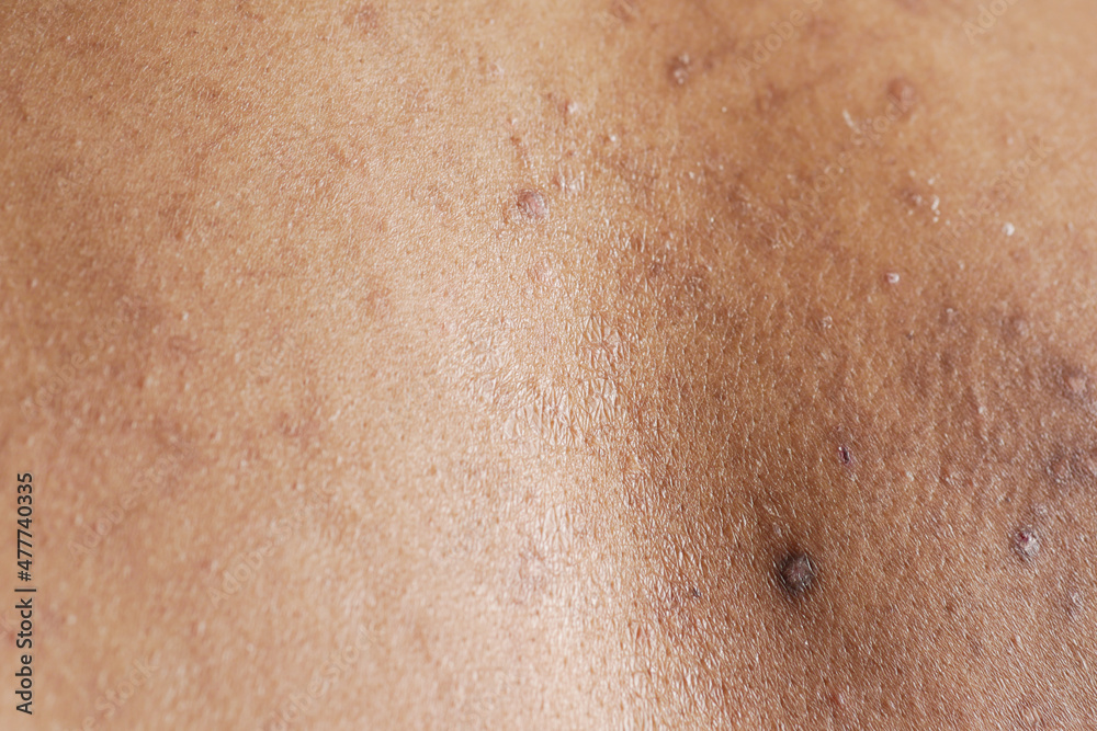 close up of young man suffering skin problem . close up of young man suffering skin problem .
