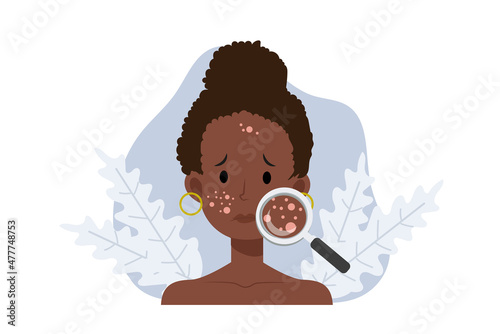 Acne skin problems Concept.African american woman with magnifying glass is looking acne on his facial. Falt vector cartoon illustration.