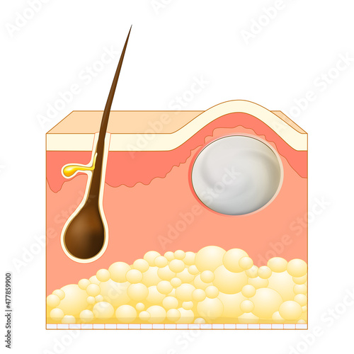 Wen, sebaceous cyst skin layers photo