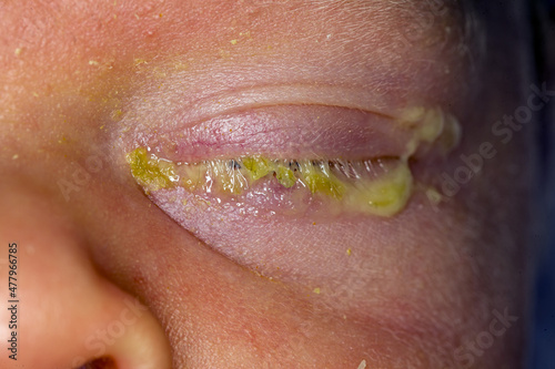 eye infection conjunctivitis in a newborn baby photo