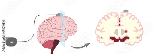 Deep brain stimulation (DBS) illustration. Electrodes placement for deep brain stimulation with a sagital perspective. photo