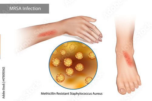 MRSA Superbug Infection. Methicillin Resistant Staphylococcus Aureus. Rashes on the arms and legs caused by staphylococcus photo