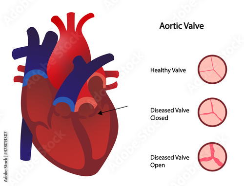 Aortic valve stenosis illustration. Healthy and disease aortica valve photo