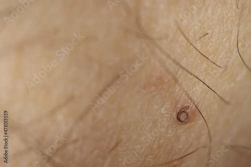 twisted ingrown hair on a white caucasian skin - shallow depth of field close-up photo