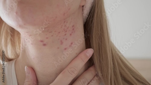 Woman with inflamed cystic acne on her neck and jawline area, close up. photo