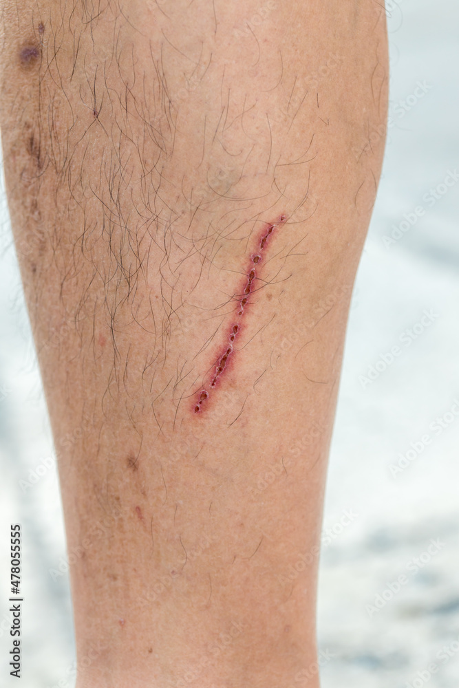 scar on skin. The wound form scabs on leg. Man with long scab wound on