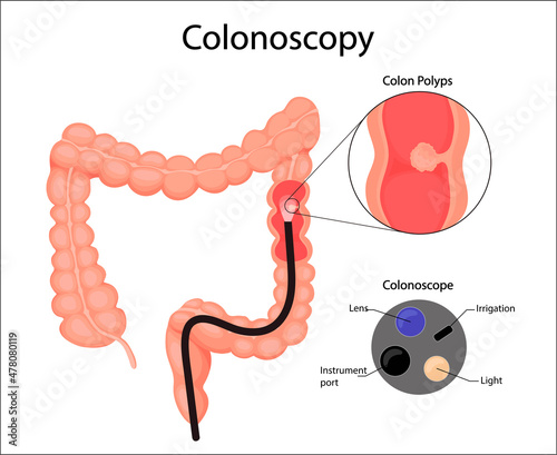 Human bladder cancer. malignant cells concept. Vector in cartoon style