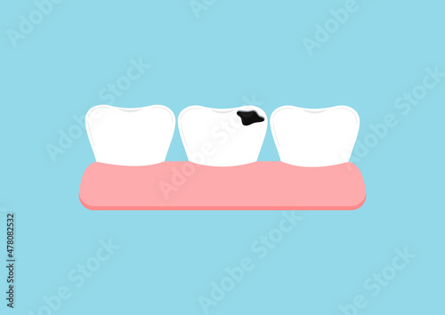 Tooth decay in gym dental icon isolated on blue background. Tooth with caries hole. Vector flat design cartoon style dentistry clip art illustration.