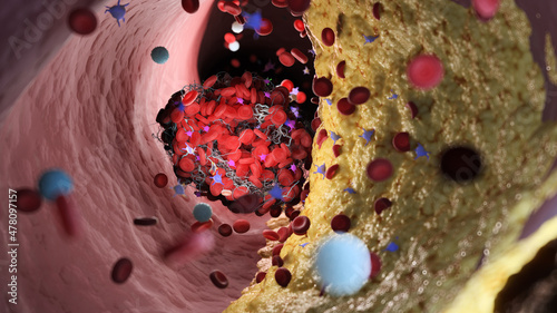 Foto 3d rendered illustration of a thrombus