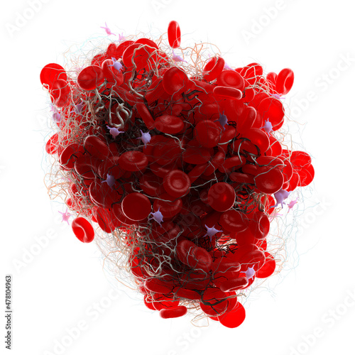 3d rendered illustration of a blood clot